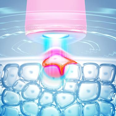  FOREO ESPADA 2 Akne Karşıtı Cilt Bakım Cihazı, Pearl Pink