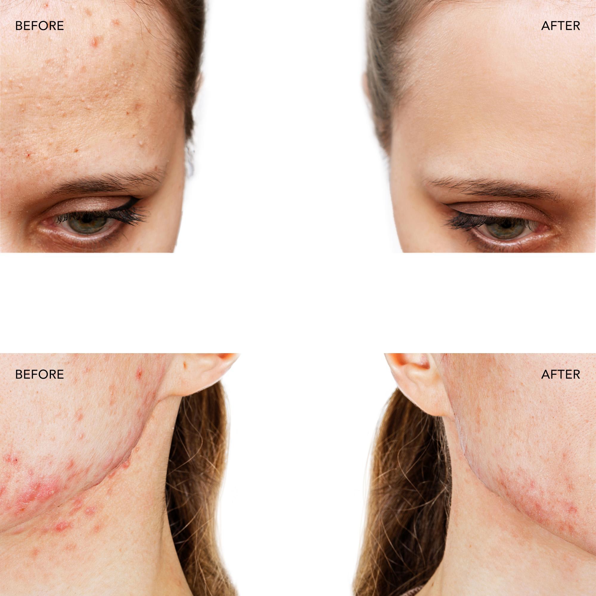 FOREO ESPADA 2 Akne Karşıtı Cilt Bakım Cihazı, Cobalt Blue