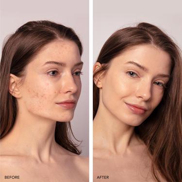  FOREO ESPADA 2 Plus Akne Karşıtı Cilt Bakım Cihazı, Lavender