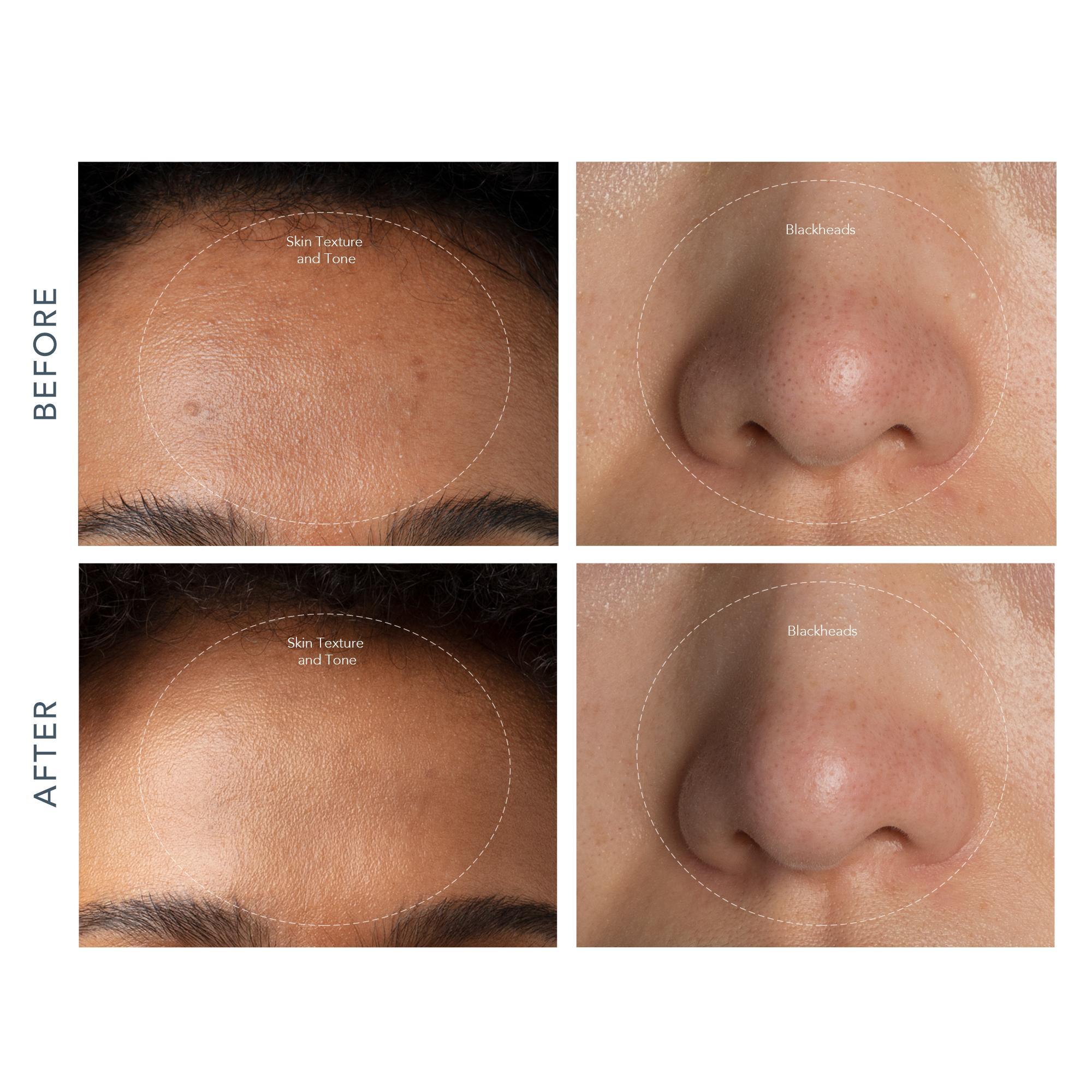 FOREO KIWI Vakumlu Siyah Nokta Temizleme Cihazı